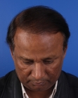After Hair Transplant&nbsp;Front